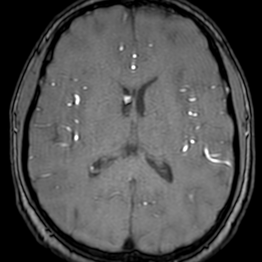 Cerebral arteriovenous malformation at posterior body of corpus callosum (Radiopaedia 74111-84925 Axial MRA 125).jpg