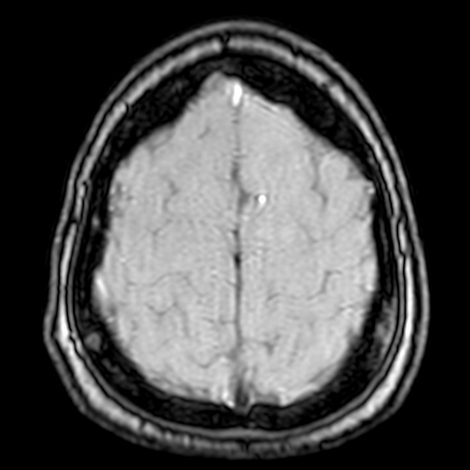 Cerebral arteriovenous malformation at posterior body of corpus callosum (Radiopaedia 74111-84925 Axial MRA 194).jpg