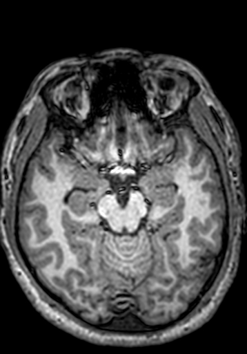 Cerebral arteriovenous malformation at posterior body of corpus callosum (Radiopaedia 74111-84925 Axial T1 192).jpg