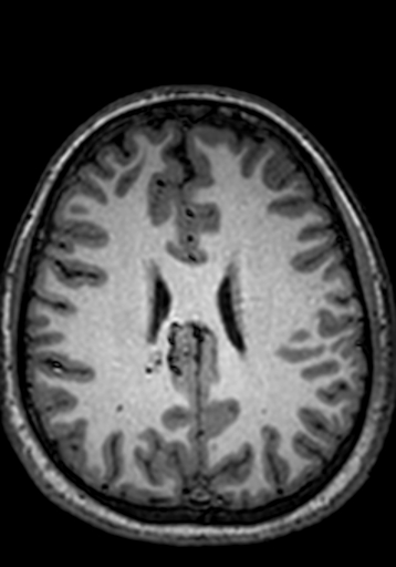Cerebral arteriovenous malformation at posterior body of corpus callosum (Radiopaedia 74111-84925 Axial T1 99).jpg