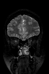 Cerebral arteriovenous malformation at posterior body of corpus callosum (Radiopaedia 74111-84925 Coronal T2 32).jpg
