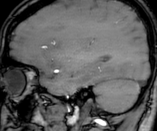 File:Cerebral arteriovenous malformation at posterior body of corpus callosum (Radiopaedia 74111-84925 J 292).jpg