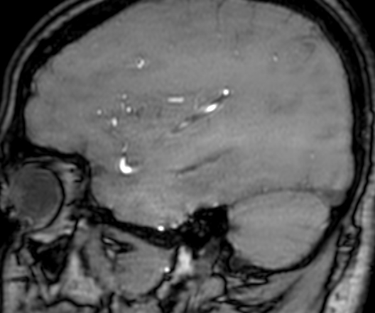 Cerebral arteriovenous malformation at posterior body of corpus callosum (Radiopaedia 74111-84925 J 303).jpg
