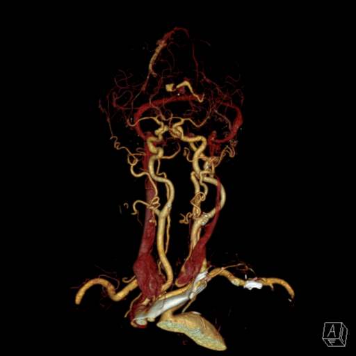 File:Cerebral arteriovenous malformation with lobar hemorrhage (Radiopaedia 44725-48512 3D VRT 4).png