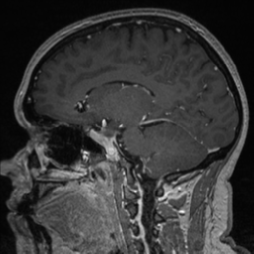 File:Cerebral cavernoma and development venous anomaly (Radiopaedia 37603-39482 Sagittal T1 C+ 42).png