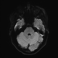 File:Cerebral cavernous venous malformation (Radiopaedia 70008-80021 Axial DWI 39).jpg