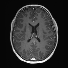 Cerebral cavernous venous malformation (Radiopaedia 70008-80021 Axial T1 C+ 48).jpg