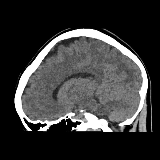 File:Cerebral cavernous venous malformation (Radiopaedia 70008-80022 C 34).jpg