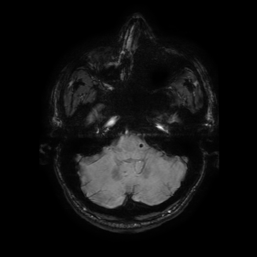Cerebral cavernous venous malformation (Zabramski type II) (Radiopaedia 85511-101198 Axial SWI 30).jpg