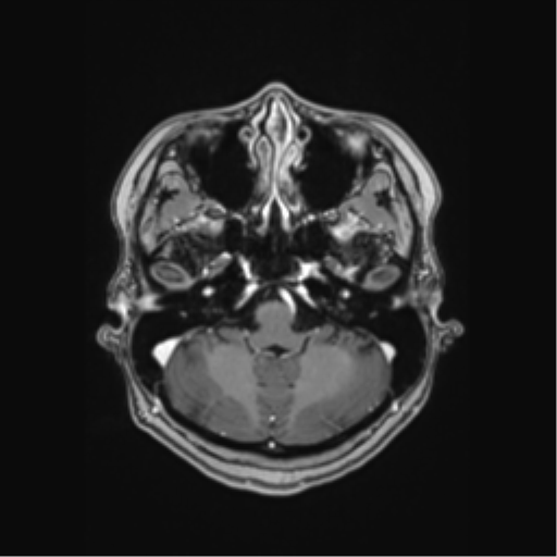 Cerebral cavernous venous malformations (Radiopaedia 48117-52946 Axial T1 C+ 8).png
