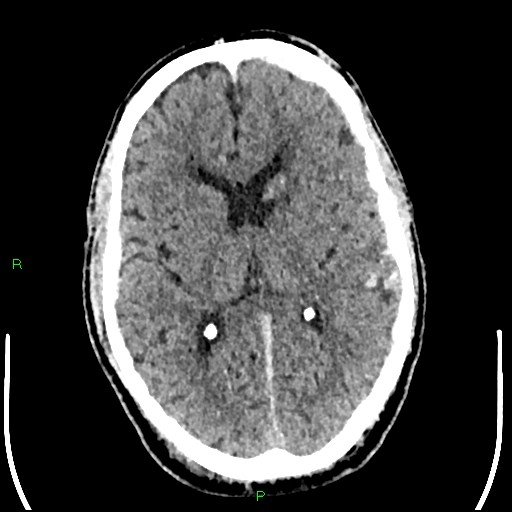 File:Cerebral contusions (Radiopaedia 33868-35039 Axial non-contrast 113).jpg