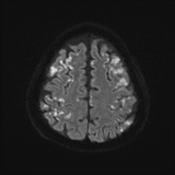 Cerebral embolic infarcts (embolic shower) (Radiopaedia 72391-82921 Axial DWI 54).jpg