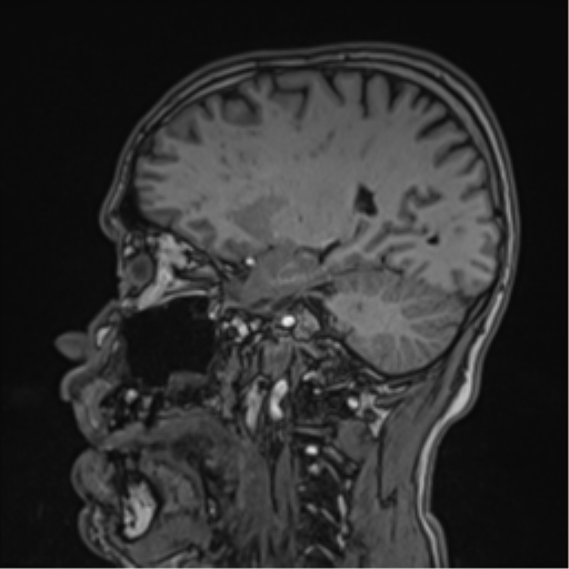 Cerebral fat embolism (Radiopaedia 57697-64639 Sagittal T1 32).png