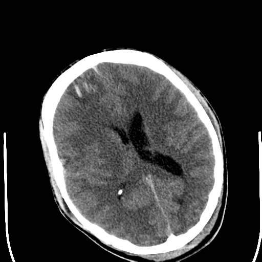 File:Cerebral hemorrhagic contusions- temporal evolution (Radiopaedia 40224-42752 Axial non-contrast 16).png