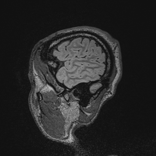 File:Cerebral hemorrhagic contusions- temporal evolution (Radiopaedia 40224-42757 Sagittal T1 12).png