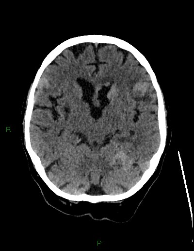 Cerebral metastases - ependymal and parenchymal (Radiopaedia 79877-93131 Axial non-contrast 30).jpg