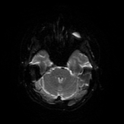 File:Cerebral metastases - melanoma (Radiopaedia 80972-94522 Axial DWI 74).jpg