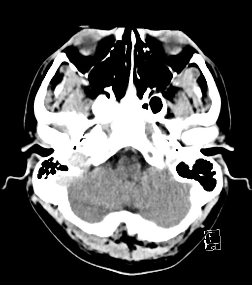Cerebral metastases - testicular choriocarcinoma (Radiopaedia 84486-99855 Axial C+ delayed 46).jpg