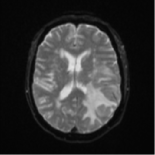 File:Cerebral metastasis (Radiopaedia 46744-51248 Axial DWI 16).png