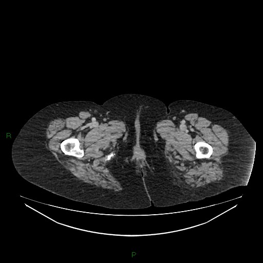Cerebral metastasis from renal cell carcinoma (Radiopaedia 82306-96378 A 217).jpg
