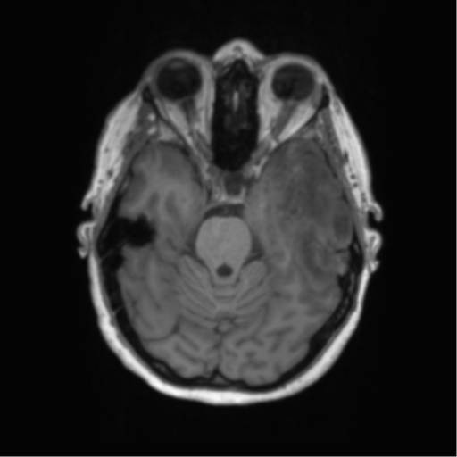 Cerebral metastasis mimicking glioblastoma (Radiopaedia 69155-78937 Axial T1 18).png