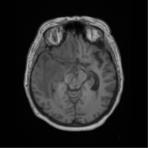 Cerebral metastasis to basal ganglia (Radiopaedia 81568-95413 Axial T1 29).png