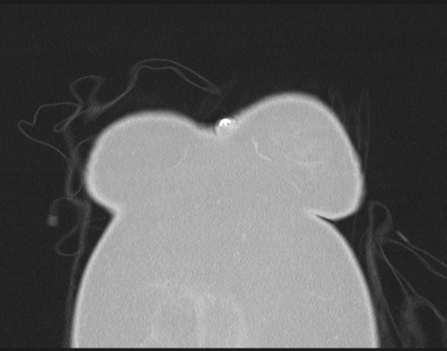 Cerebral metastasis to basal ganglia (Radiopaedia 81568-95414 Coronal lung window 7).png