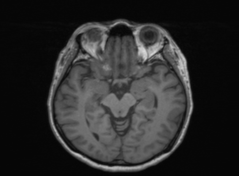 Cerebral ring enhancing lesions - cerebral metastases (Radiopaedia 44922-48817 Axial T1 254).jpg