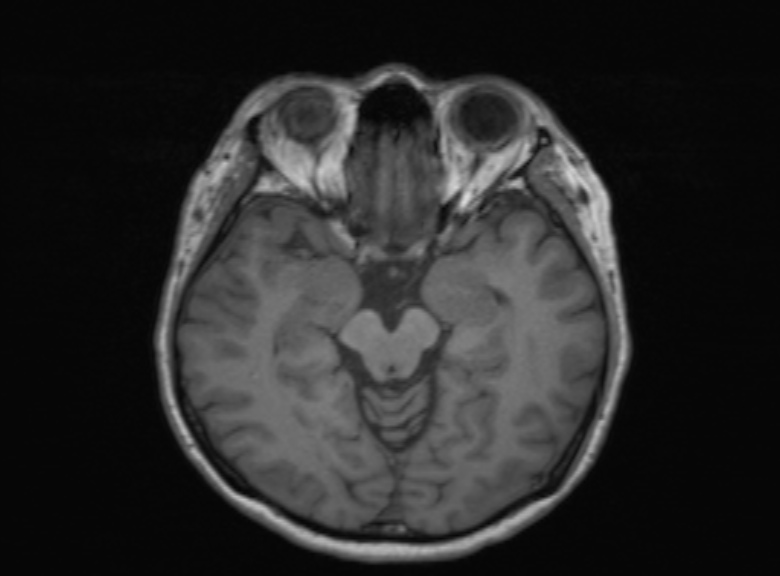 Cerebral ring enhancing lesions - cerebral metastases (Radiopaedia 44922-48817 Axial T1 259).jpg