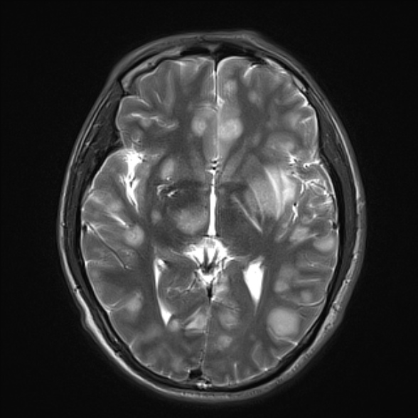 File:Cerebral toxoplasmosis (Radiopaedia 53993-60132 Axial T2 13).jpg