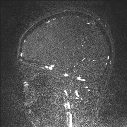 Cerebral tuberculosis with dural sinus invasion (Radiopaedia 60353-68090 Sagittal MRV 50).jpg