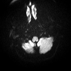 File:Cerebral venous infarction - hemorrhagic (Radiopaedia 81625-95505 Axial DWI 2).jpg