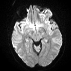 File:Cerebral venous infarction - hemorrhagic (Radiopaedia 81625-95505 Axial DWI 9).jpg