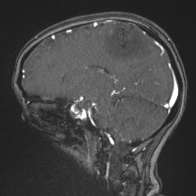 Cerebral venous infarction - hemorrhagic (Radiopaedia 81625-95505 Sagittal MRV 34).jpg