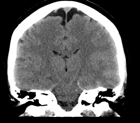 File:Cerebral venous infarction due to transverse sinus thrombosis (Radiopaedia 34688-36116 Coronal non-contrast 21).png