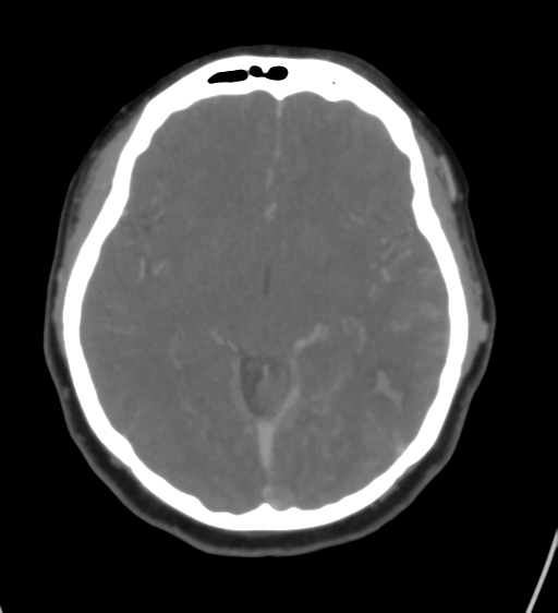 Cerebral venous infarction due to transverse sinus thrombosis (Radiopaedia 34688-36120 Axial CT venogram 24).png