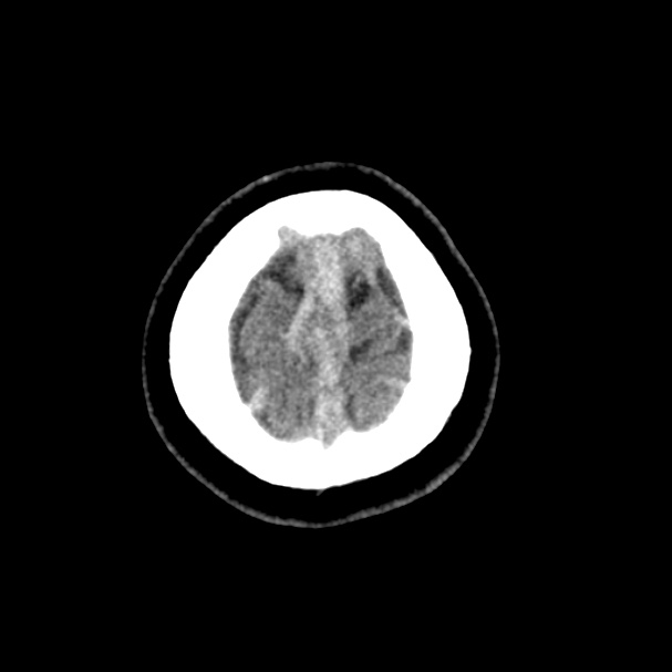 Cerebral venous sinus thrombosis (Radiopaedia 59224-66551 Axial non-contrast 56).jpg