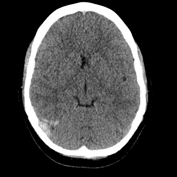 Cerebral venous sinus thrombosis (Radiopaedia 59224-66551 Axial non-contrast 7).jpg