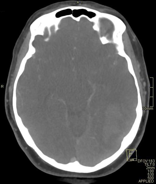 Cerebral venous sinus thrombosis (Radiopaedia 91329-108965 Axial venogram 36).jpg