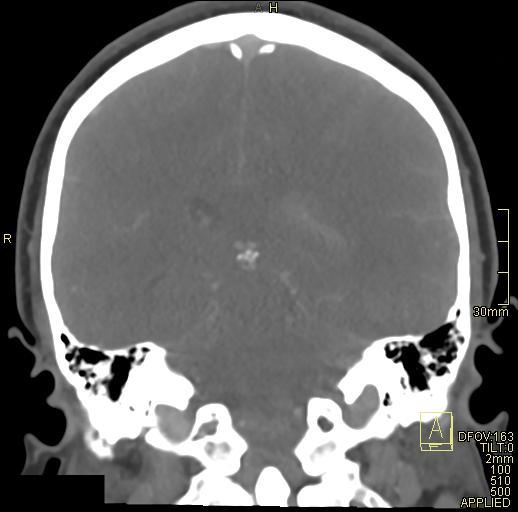 Cerebral venous sinus thrombosis (Radiopaedia 91329-108965 Coronal venogram 55).jpg