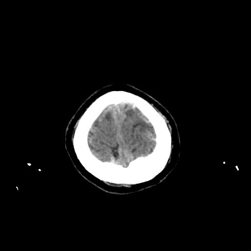 File:Cerebral venous throbmosis - hemorrhagic venous infarction (Radiopaedia 87318-103613 Axial non-contrast 166).jpg
