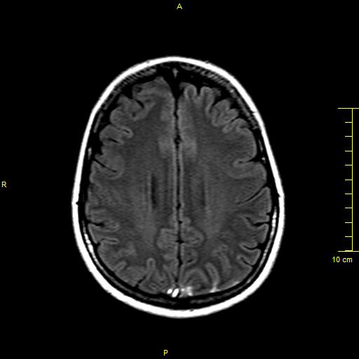 File:Cerebral venous thrombosis (Radiopaedia 23288-23351 Axial FLAIR 14).JPG