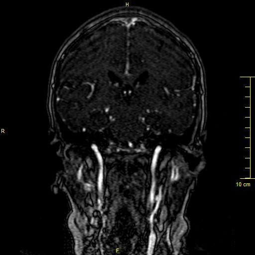 File:Cerebral venous thrombosis (Radiopaedia 23288-23351 MRV 85).JPG