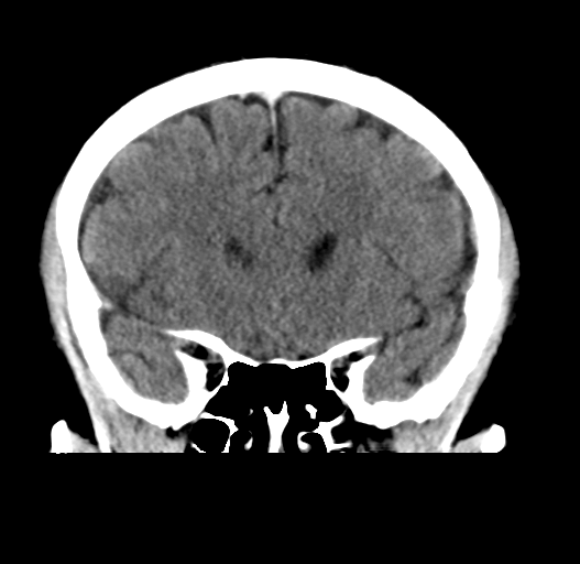 File:Cerebral venous thrombosis (Radiopaedia 38392-40467 Coronal non-contrast 13).png