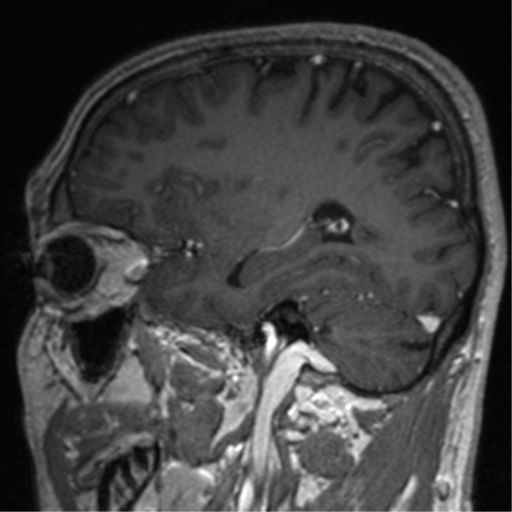 File:Cerebral venous thrombosis (Radiopaedia 38392-40469 Sagittal T1 C+ 61).png