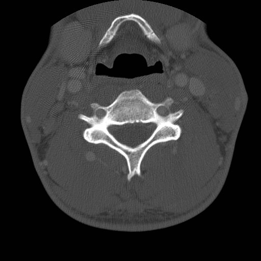 Cervical Pott disease (Radiopaedia 20374-20286 Axial bone window 83).jpg