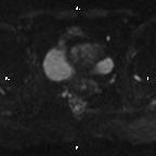 Cervical adenocarcinoma (Radiopaedia 65011-73985 Axial DWI 38).jpg