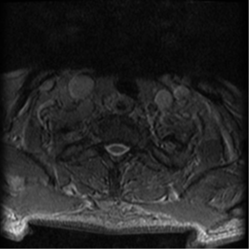 Cervical canal stenosis with cord compression (Radiopaedia 34114-35374 Axial Gradient Echo 9).png
