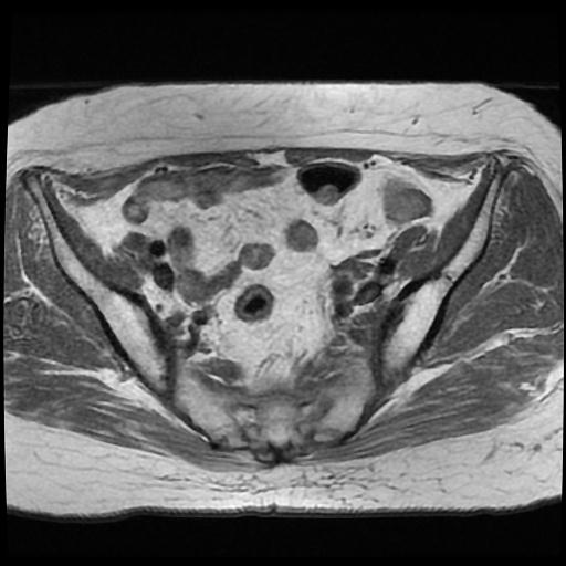 File:Cervical carcinoma (Radiopaedia 70924-81132 Axial T1 2).jpg