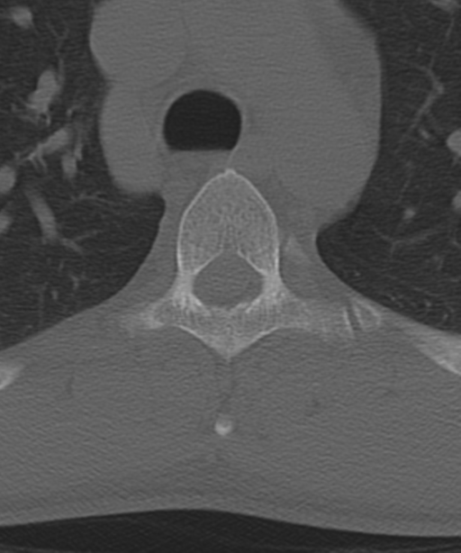 Cervical intercalary bone (Radiopaedia 35211-36748 Axial bone window 81).png